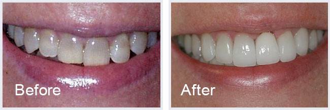 Before After