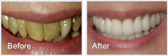 Before After