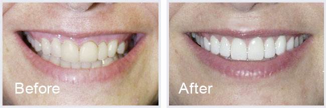 Before After