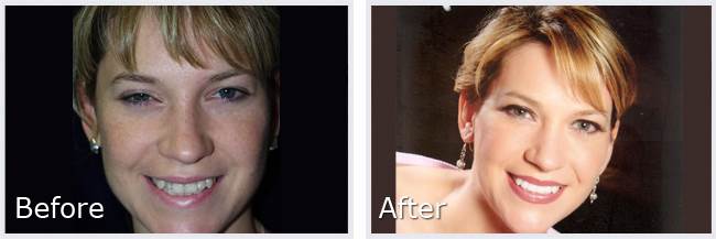 Before After