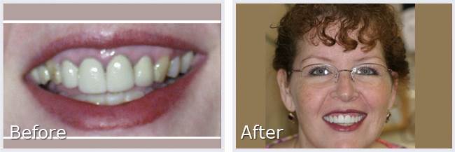 Before After
