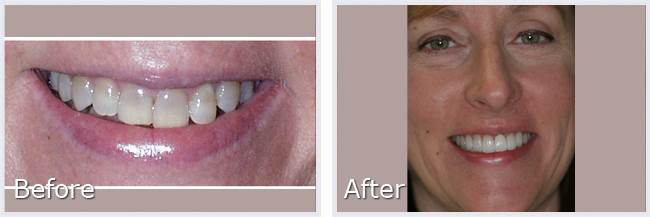 Before After