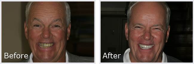 Before After