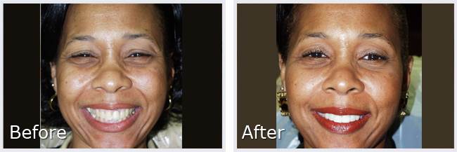Before After