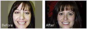 before-after6