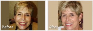 before-after8