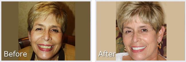 Before After