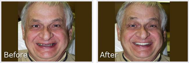 Before After