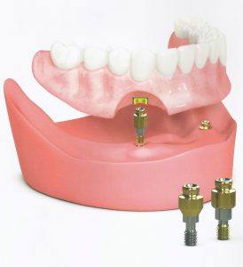 permanent dentures with a Timonium dentist Towson MD and Pikesville