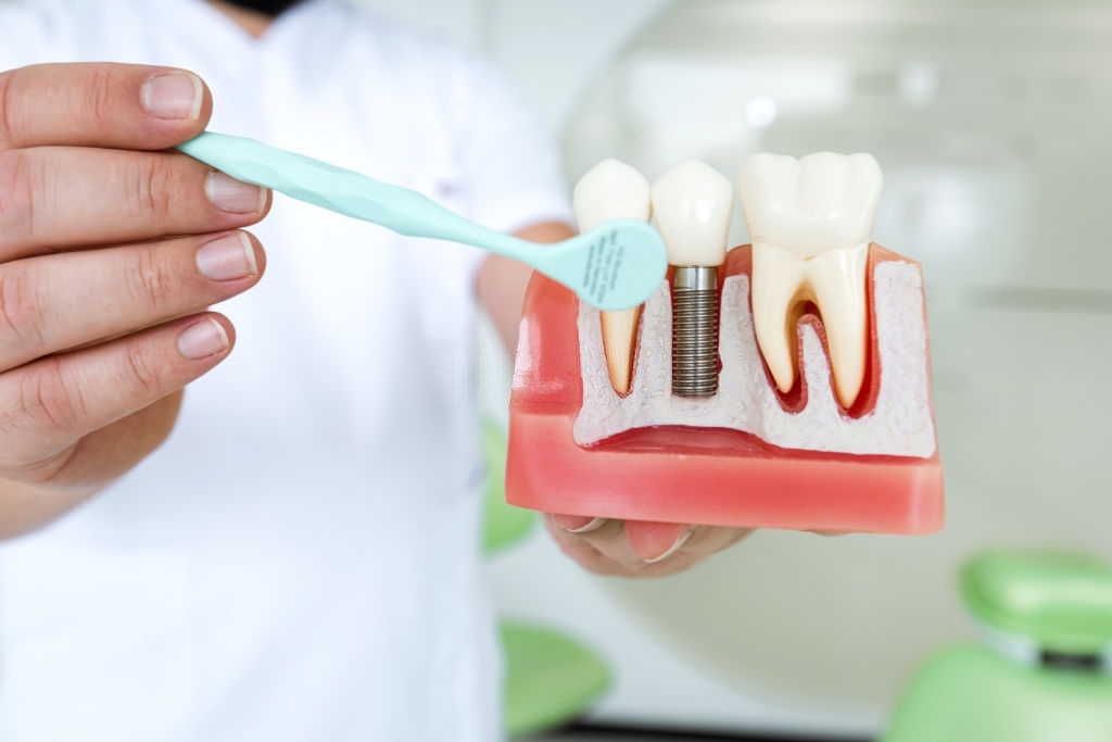 What Are Dental Implants