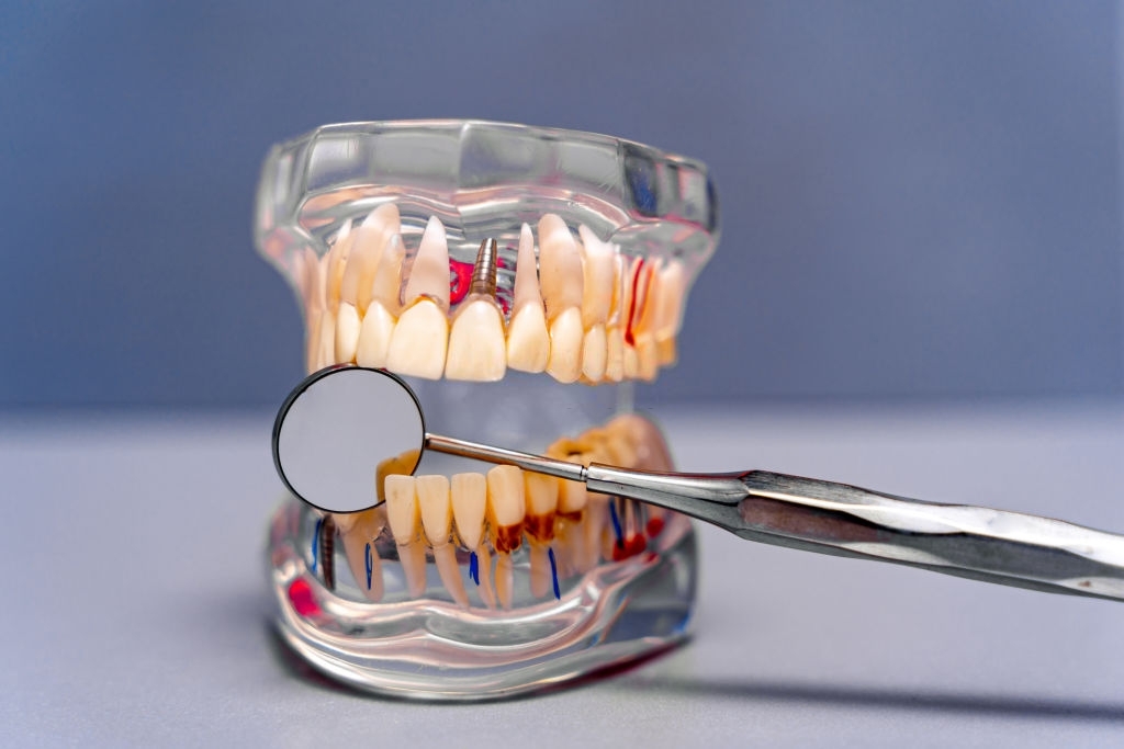 Full Mouth Dental Implants